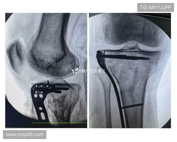 武磊膝微骨折手术欧洲名医主刀